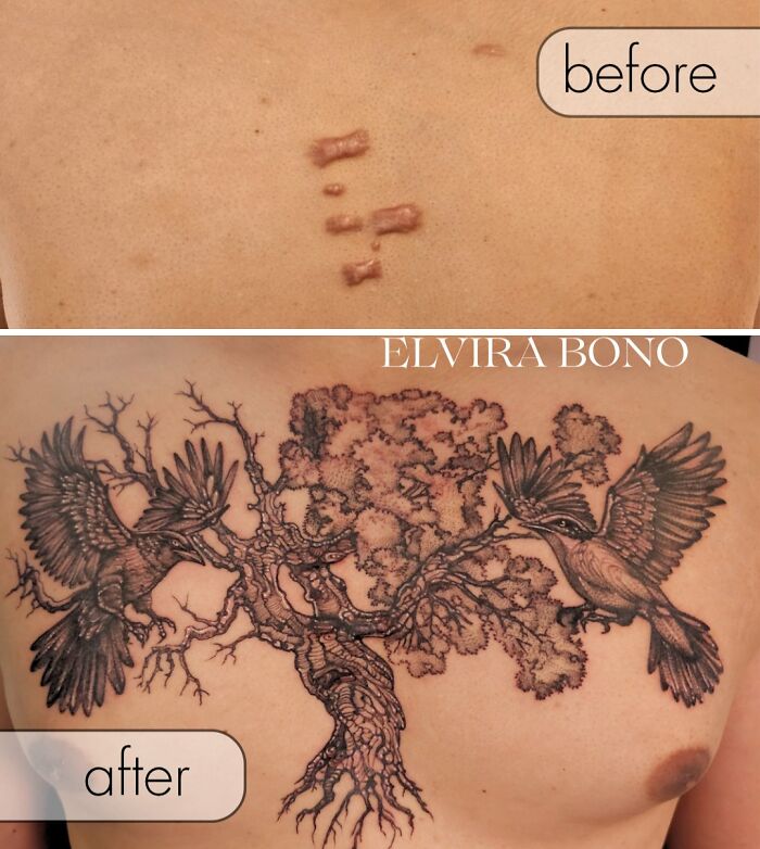 Tattoo On Scars Of Keloids