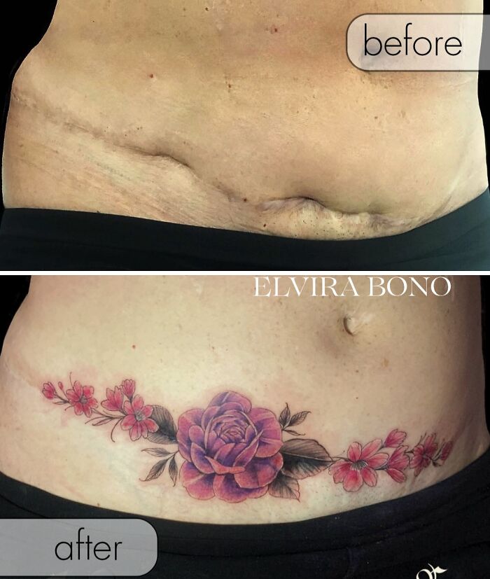 Tattoo In Abdominoplasty Scar With Deep Areas Due To Complications