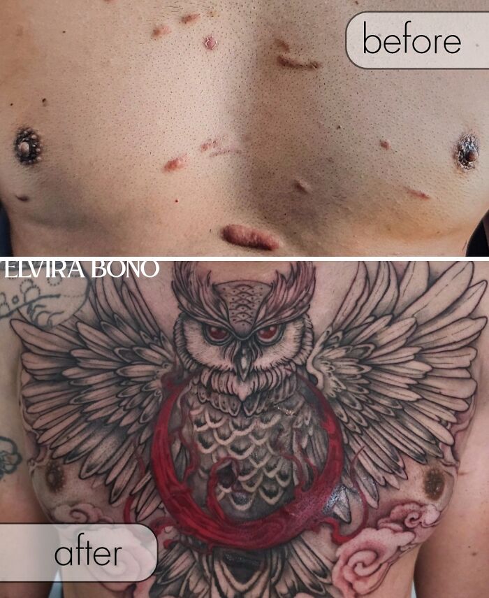 Tattoo On Acne Scars With Keloid