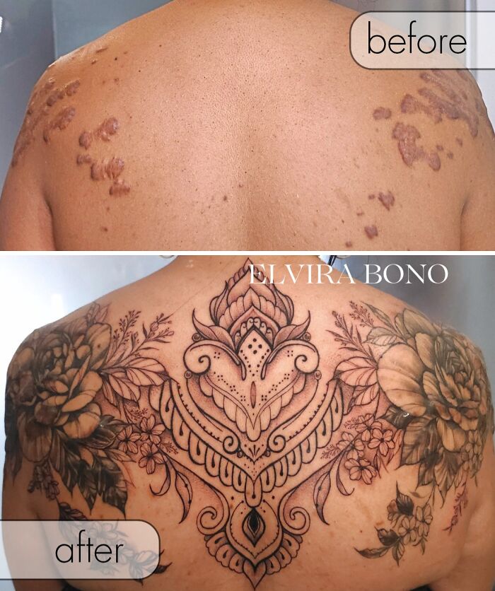 Tattoo On Acne Scar With Keloid