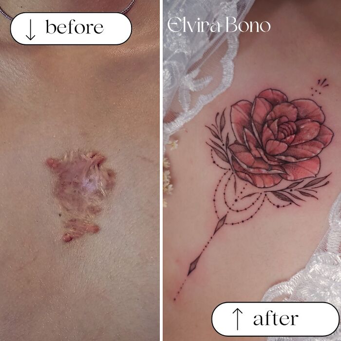 Tattoo On A Keloid Scar