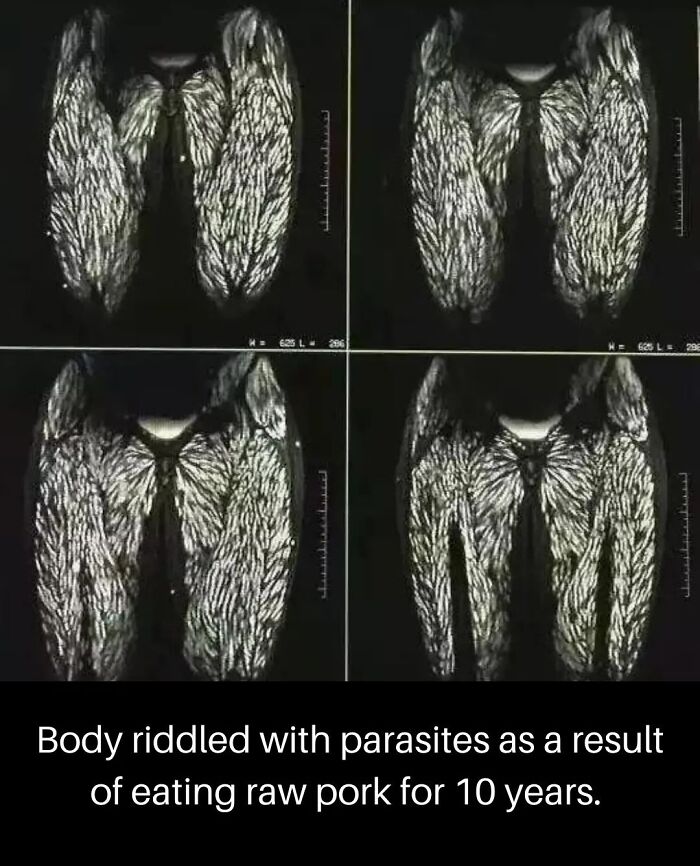 Four MRI scans show a body riddled with parasites, a truly creepy image and nightmare fuel.
