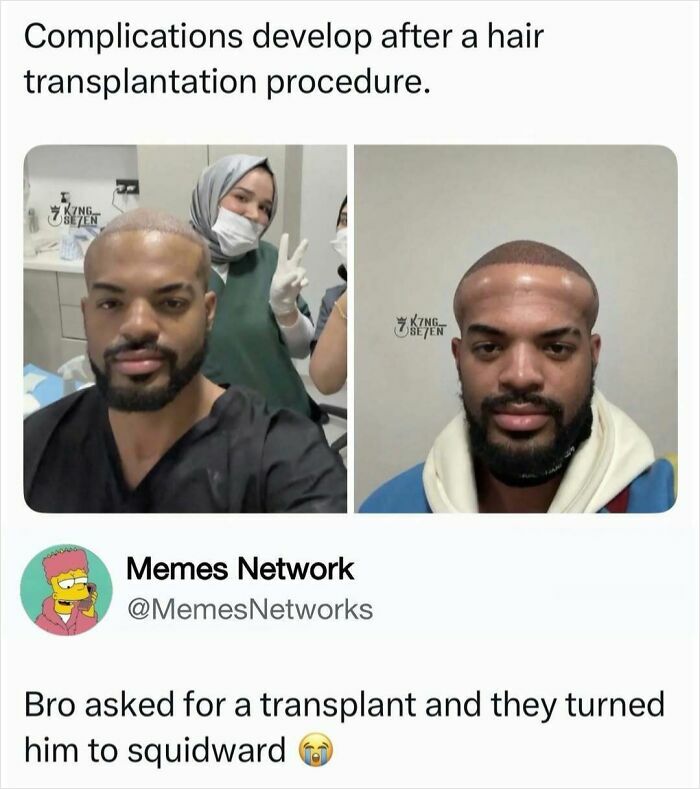 A meme comparing a man after a hair transplant to Squidward, for a quick laugh.