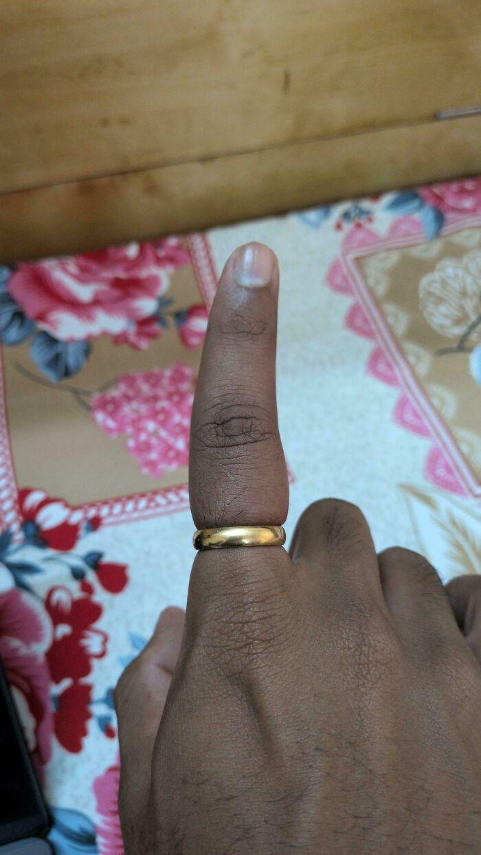 A hand with a gold ring stuck on the thumb, showcasing a common problem and asking for help fixing things.