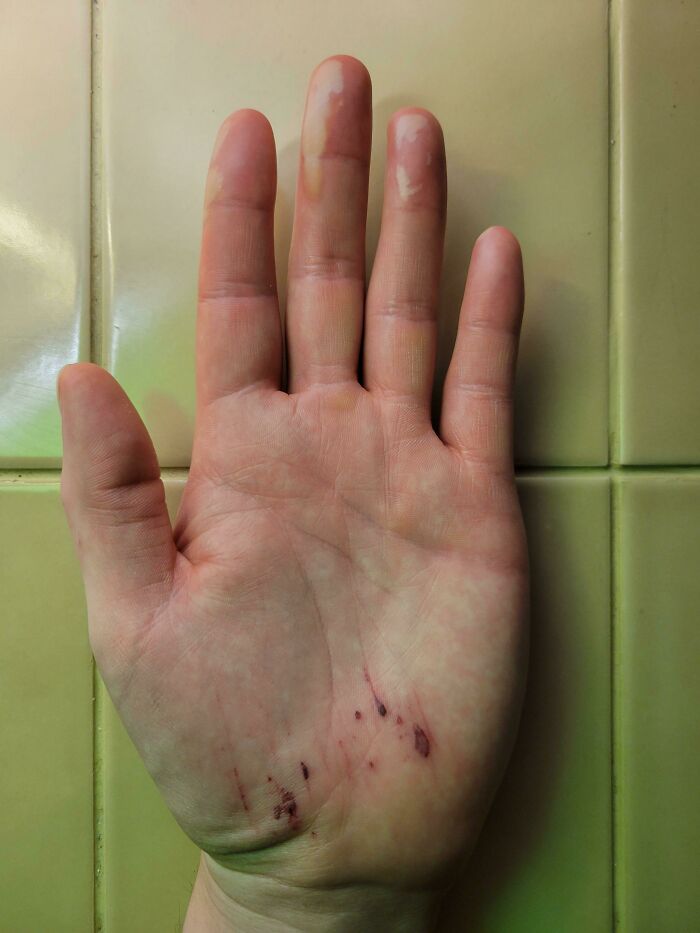 A hand with blisters and scratches on the palm and fingers, having a worse day than you.