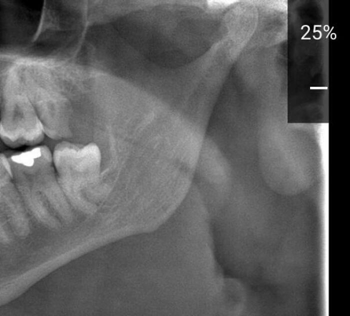 The Dentist Laughed At My ‘Dancing’ Wisdom Tooth