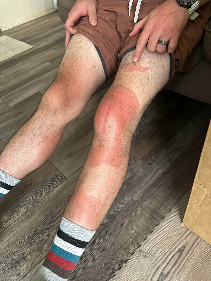A man's legs with severe sunburn lines, an instance of people ruining their day by forgetting sunscreen.