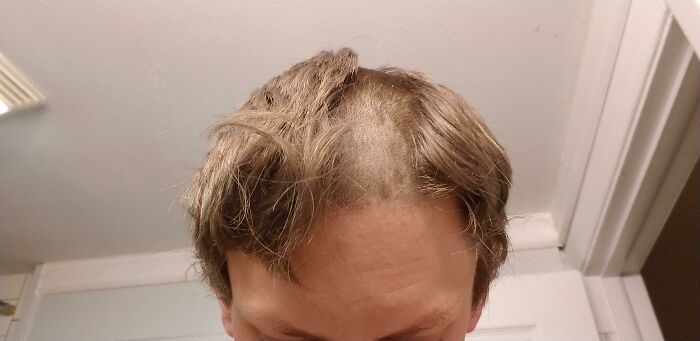 A person with a large patch of shaved hair on their head, illustrating how easily people ruin their day.