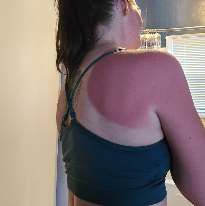 A person with a severe sunburn pattern on their back and shoulder, forgetting sun protection, ruining their day.