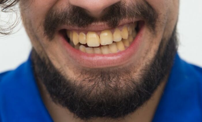 Close-up of a man with yellowed teeth and a beard, showing a wide smile that might be part of an amazing comeback.