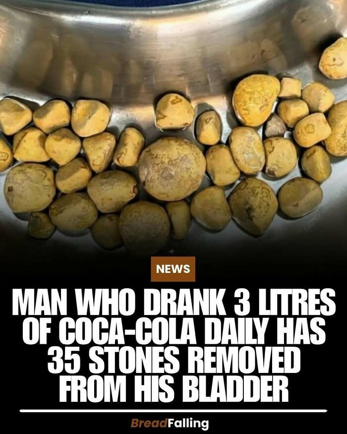 An interesting fact about 35 stones removed from a man who drank Coca-Cola daily.
