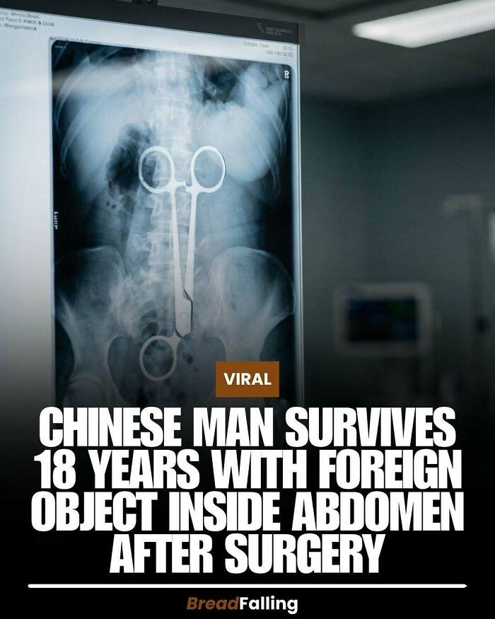 Interesting fact: Chinese man survived 18 years with a foreign object, an amazing productivity fact.