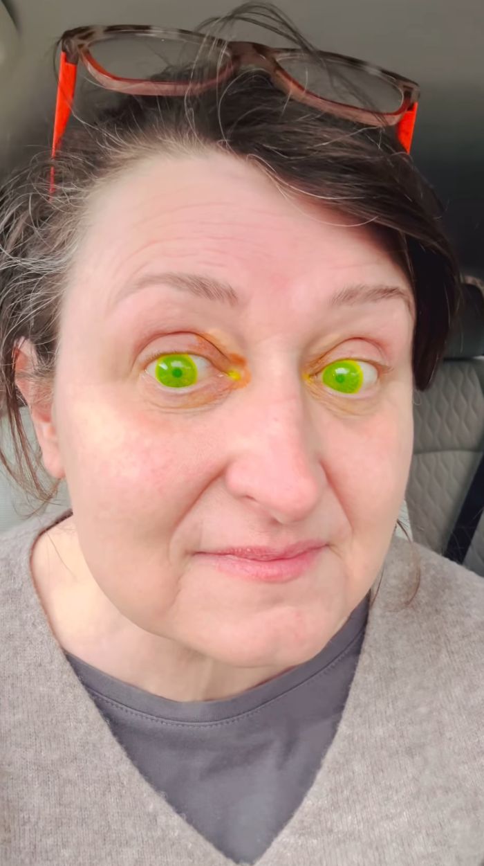 Woman with fluorescent green pupils after a routine eye exam, surprising experts. Woman with fluorescent green pupils after a routine eye exam, surprising experts.