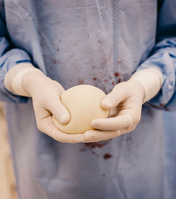 Surgeon's gloved hands holding a removed breast implant, stained with blood, during a removal procedure. Surgeon's gloved hands holding a removed breast implant, stained with blood, during a removal procedure.