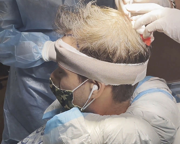 A lookmaxxer undergoing a medical procedure on his head, part of his extreme transformation. A lookmaxxer undergoing a medical procedure on his head, part of his extreme transformation.
