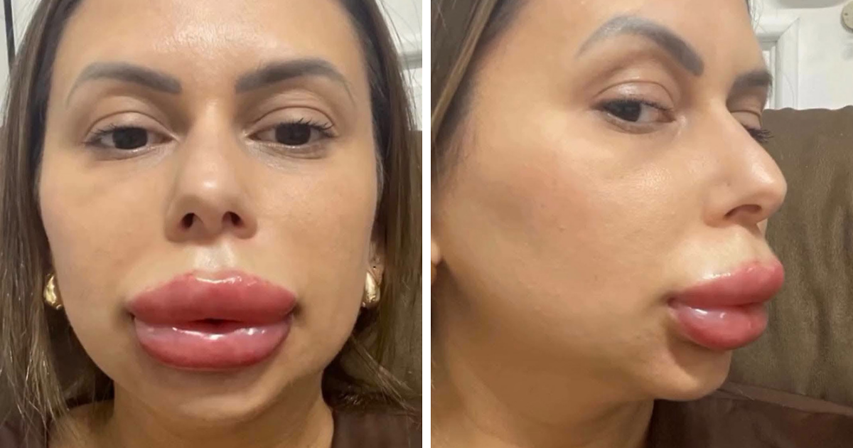 Woman’s Cosmetic Procedure Goes Viral As Her Face Changes Dramatically, Expert Weighs In And Explains The Risks