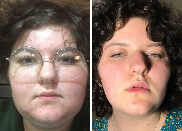 A woman's before and after comparison of her face, showing changes. People left speechless at reunions.