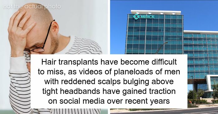 Hair Transplants Carry A Life-Changing Risk That Nobody Is Talking About