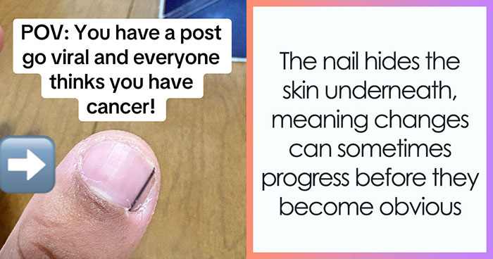 Man’s Viral Costco Chicken Clip Sparks Concern As Viewers Notice Dark Nail Stripe, Expert Explains What It Means