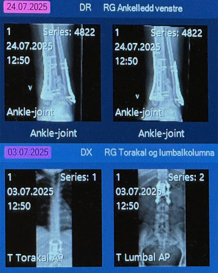 Medical X-ray images displaying ankle and spine injuries, indicating the fight for life after a party. Medical X-ray images displaying ankle and spine injuries, indicating the fight for life after a party.