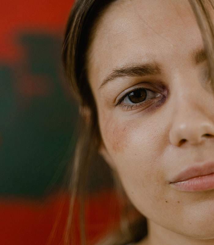 A woman with a black eye, a clear wedding red flag, signaling an unhappy marriage.