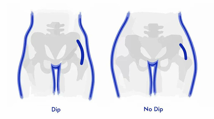 Diagram comparing a figure with a hip dip versus one without, visually defining hip dips.