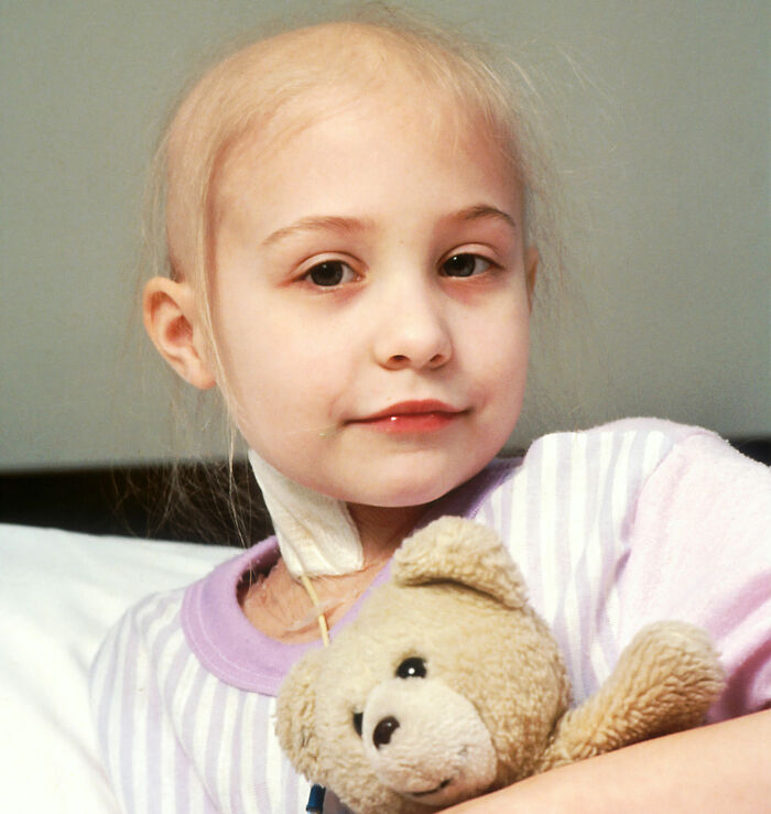 Young girl with cancer and partially bald, holding a teddy bear, illustrating a classmate with cancer. Young girl with cancer and partially bald, holding a teddy bear, illustrating a classmate with cancer.