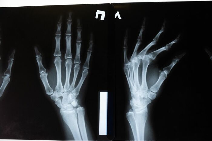 X-rays of two hands, one seemingly normal and the other with visible bone abnormalities, showing disturbing facts about human anatomy.
