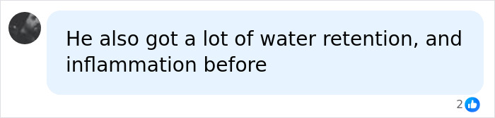 Comment about the man's water retention and inflammation before attending Chinese fat camp for his before-and-after. Comment about the man's water retention and inflammation before attending Chinese fat camp for his before-and-after.