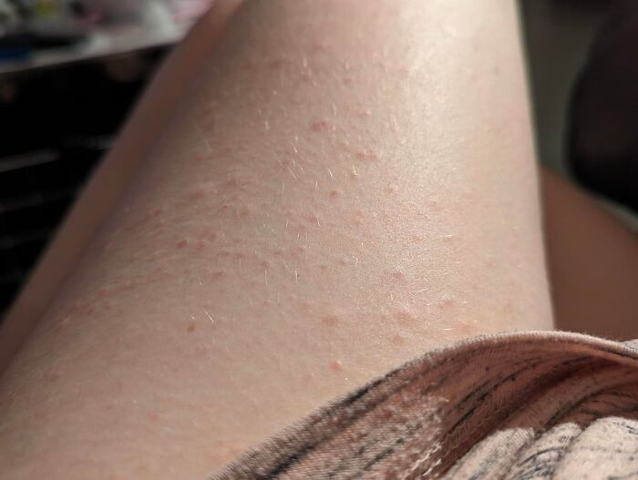 A close-up of a person's leg with small red bumps, revealing disturbing facts about skin conditions.
