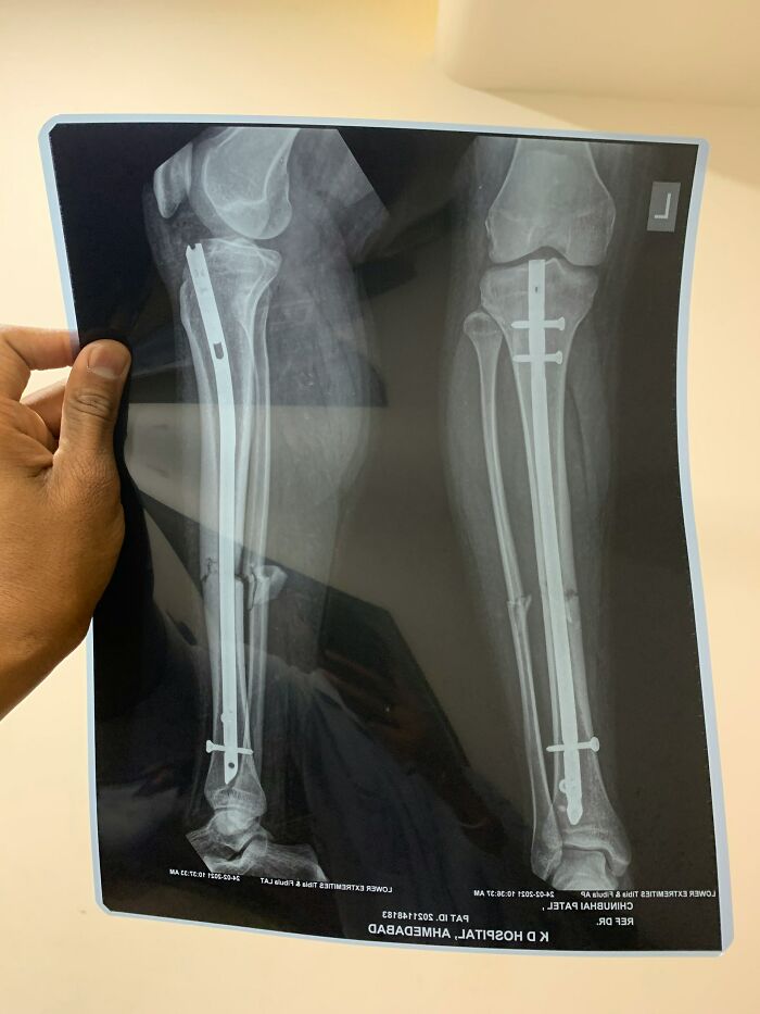 An X-ray showing a leg with an internal fixation, depicting the consequences of medical mistakes.