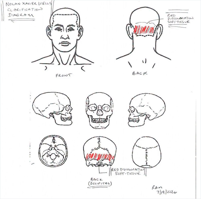 Autopsy results diagram for Nolan Wells case, showing red discoloration on the back of the skull and head.