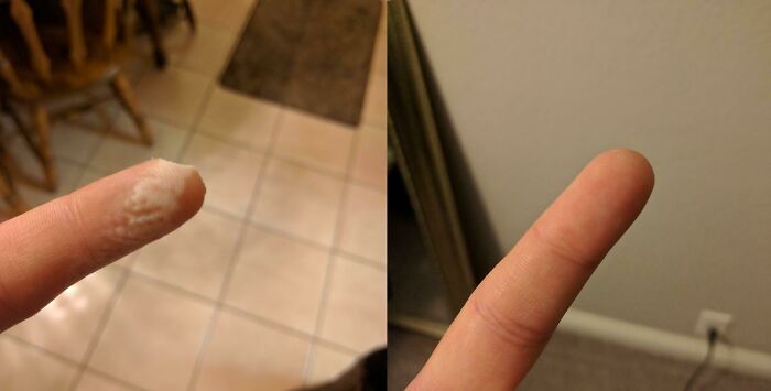 Before-and-after image of a finger showing a removed wart, proving the strange and amazing human body.