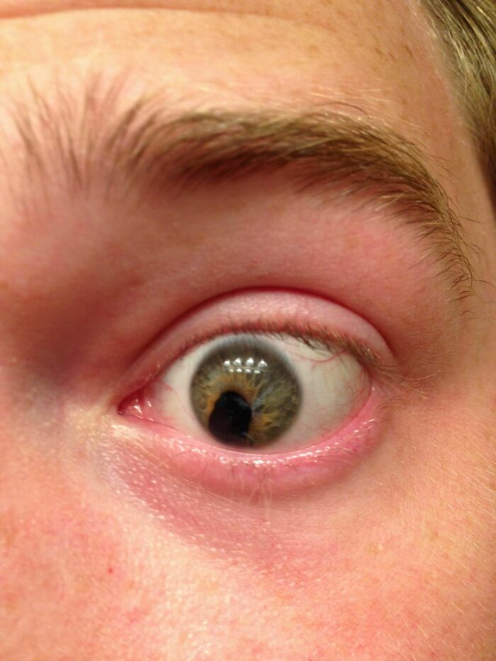 A close-up of a human eye with an irregularly shaped pupil, showcasing the strange human body.