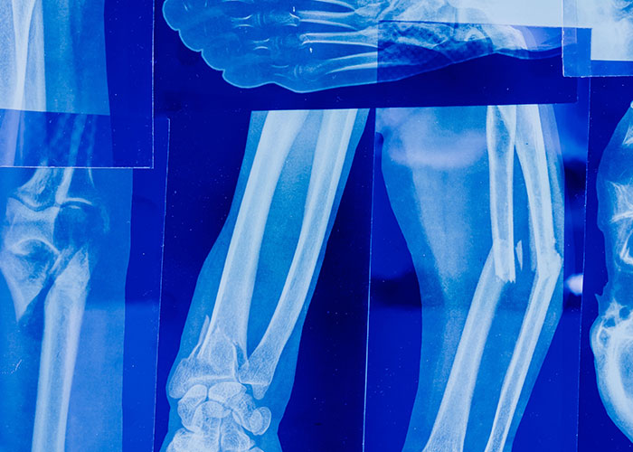 An x-ray image shows a broken arm, highlighting amazing human body facts.