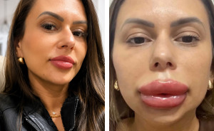 Woman’s Cosmetic Procedure Goes Viral As Her Face Changes Dramatically, Expert Weighs In And Explains The Risks