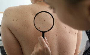 Dermatologist Reveals The Major Red Flag On Your Skin That Could Signal Heart Problems
