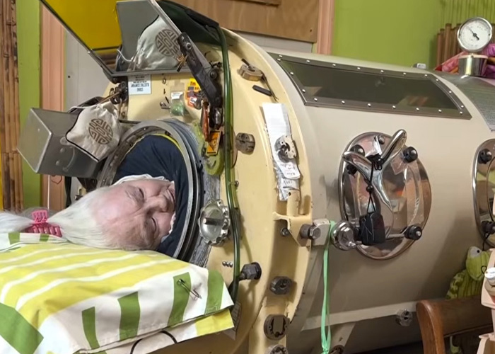 A 78-year-old polio survivor living in an iron lung machine, with her head resting on a striped pillow.