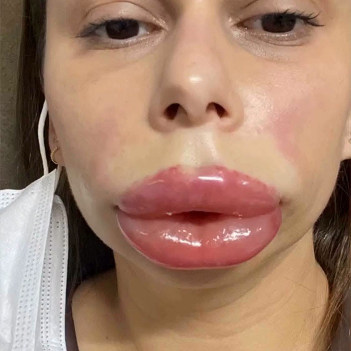 Woman's face dramatically changed after a cosmetic procedure, showing swollen lips and facial area, illustrating risks. Woman's face dramatically changed after a cosmetic procedure, showing swollen lips and facial area, illustrating risks.