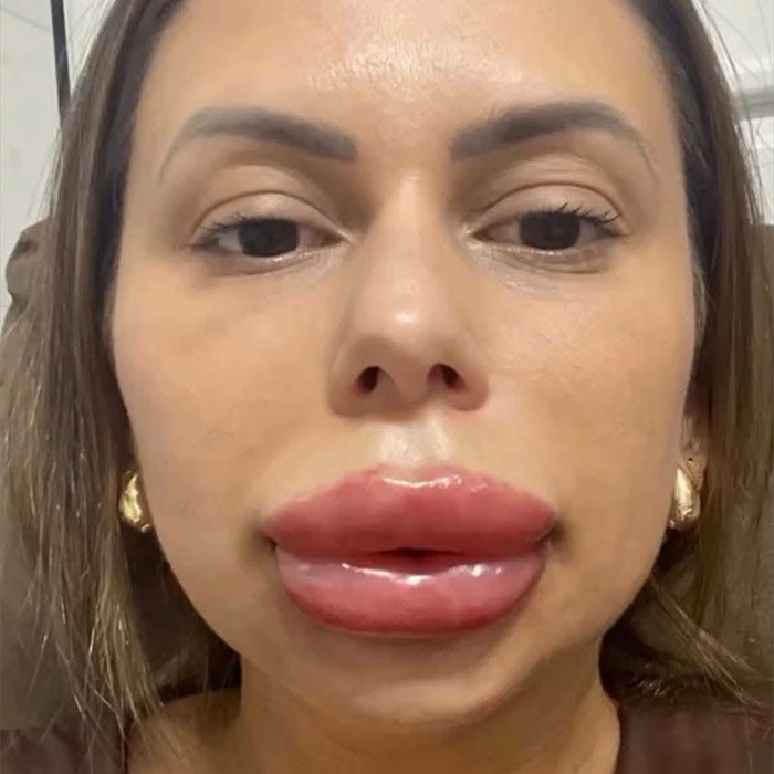 Front view of a woman with dramatically swollen lips after a cosmetic procedure, highlighting risks. Front view of a woman with dramatically swollen lips after a cosmetic procedure, highlighting risks.