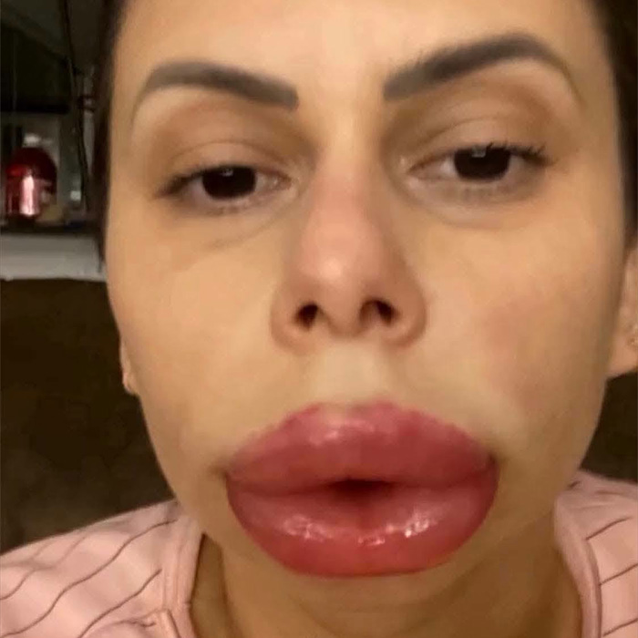 Close-up of a woman's face with severely enlarged lips following a cosmetic procedure, emphasizing risks. Close-up of a woman's face with severely enlarged lips following a cosmetic procedure, emphasizing risks.