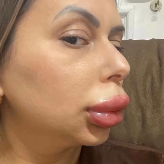 Side view of a woman's face with extremely swollen lips from a cosmetic procedure, showing dramatic changes. Side view of a woman's face with extremely swollen lips from a cosmetic procedure, showing dramatic changes.