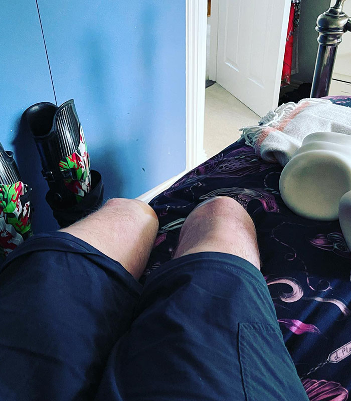 A man's amputated legs with prosthetic limbs beside him, revealing the horrific crimes of the surgeon.
