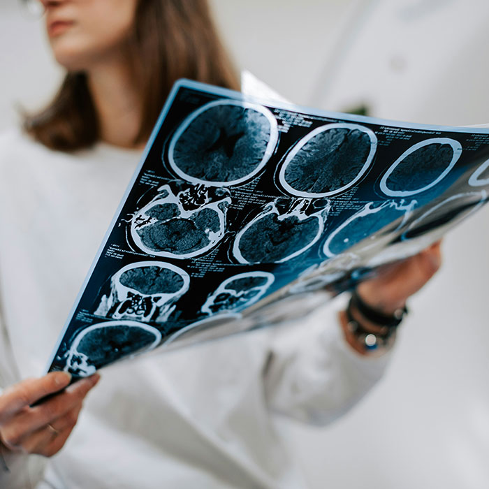 Person holding CT scans showing brain images, related to diagnosing cancer symptoms. Person holding CT scans showing brain images, related to diagnosing cancer symptoms.