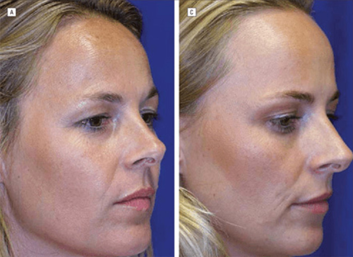Profile views of identical twins revealing dramatic differences in facial appearance, with one twin using Botox. Profile views of identical twins revealing dramatic differences in facial appearance, with one twin using Botox.