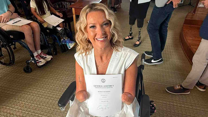 A smiling woman who had both legs and hands amputated after surgery holds a certificate in her wheelchair. A smiling woman who had both legs and hands amputated after surgery holds a certificate in her wheelchair.