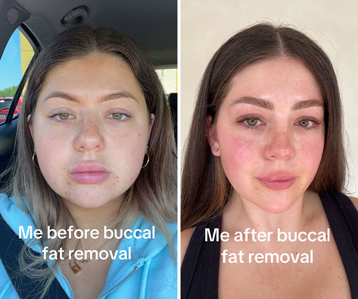 After Anya Taylor-Joy Seemingly Went Back On Her Buccal Fat Removal, Expert Weighs In On Reversal Procedure After Anya Taylor-Joy Seemingly Went Back On Her Buccal Fat Removal, Expert Weighs In On Reversal Procedure