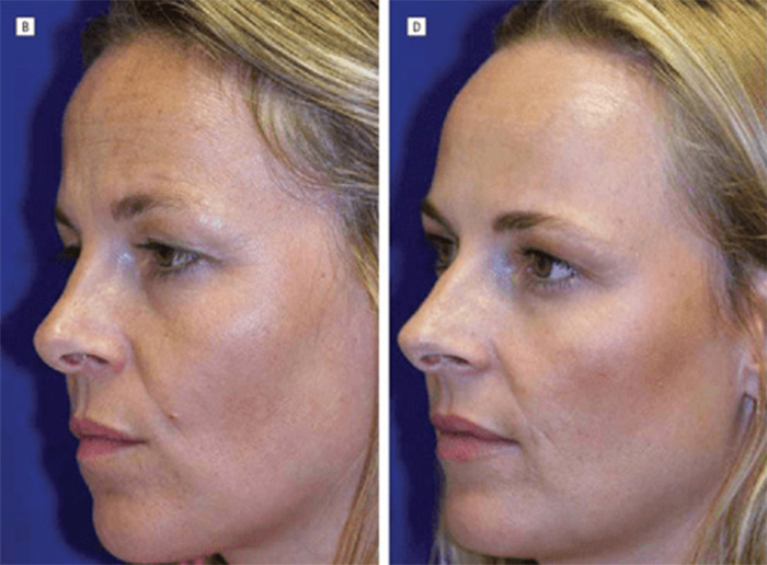 A split image of identical twins, showcasing dramatic differences in their faces, with one twin using Botox. A split image of identical twins, showcasing dramatic differences in their faces, with one twin using Botox.