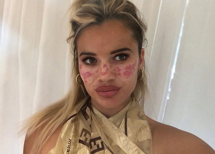 Reality star shows her scarred face after attempting to tattoo fake freckles for a viral trend, inspiring her new brand. Reality star shows her scarred face after attempting to tattoo fake freckles for a viral trend, inspiring her new brand.