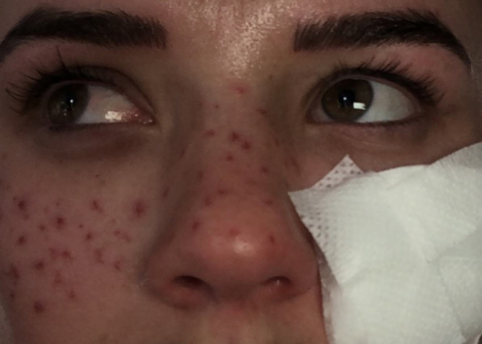 Close-up of a scarred face after a tattooing attempt for a viral trend. Close-up of a scarred face after a tattooing attempt for a viral trend.